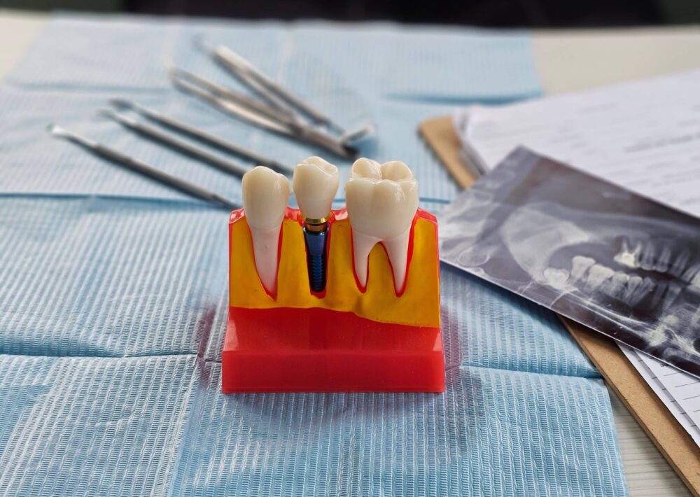 dental implants roosevelt