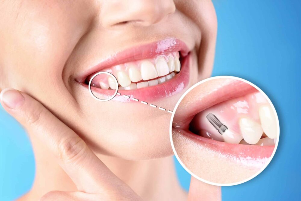 dental implants roosevelt